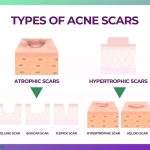Acne_Scars